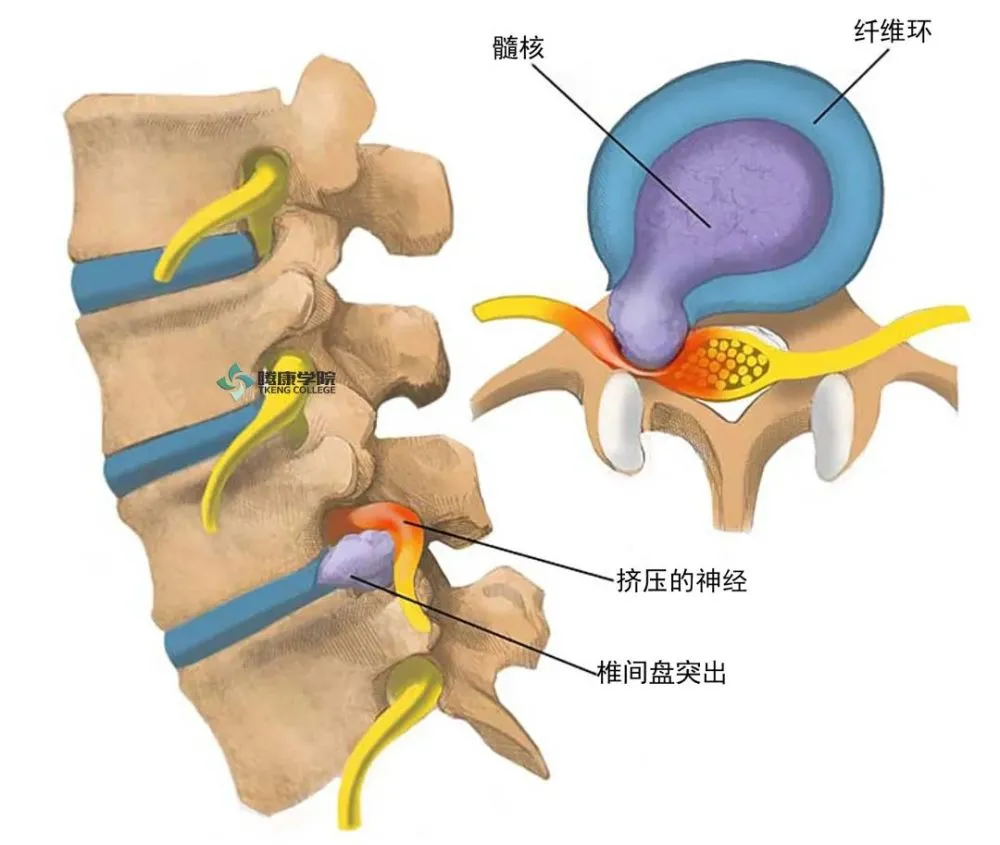 腰椎间盘突出症的锻炼方法图片_腰椎间盘突出症如何锻炼方法_急性腰椎突出症 比例